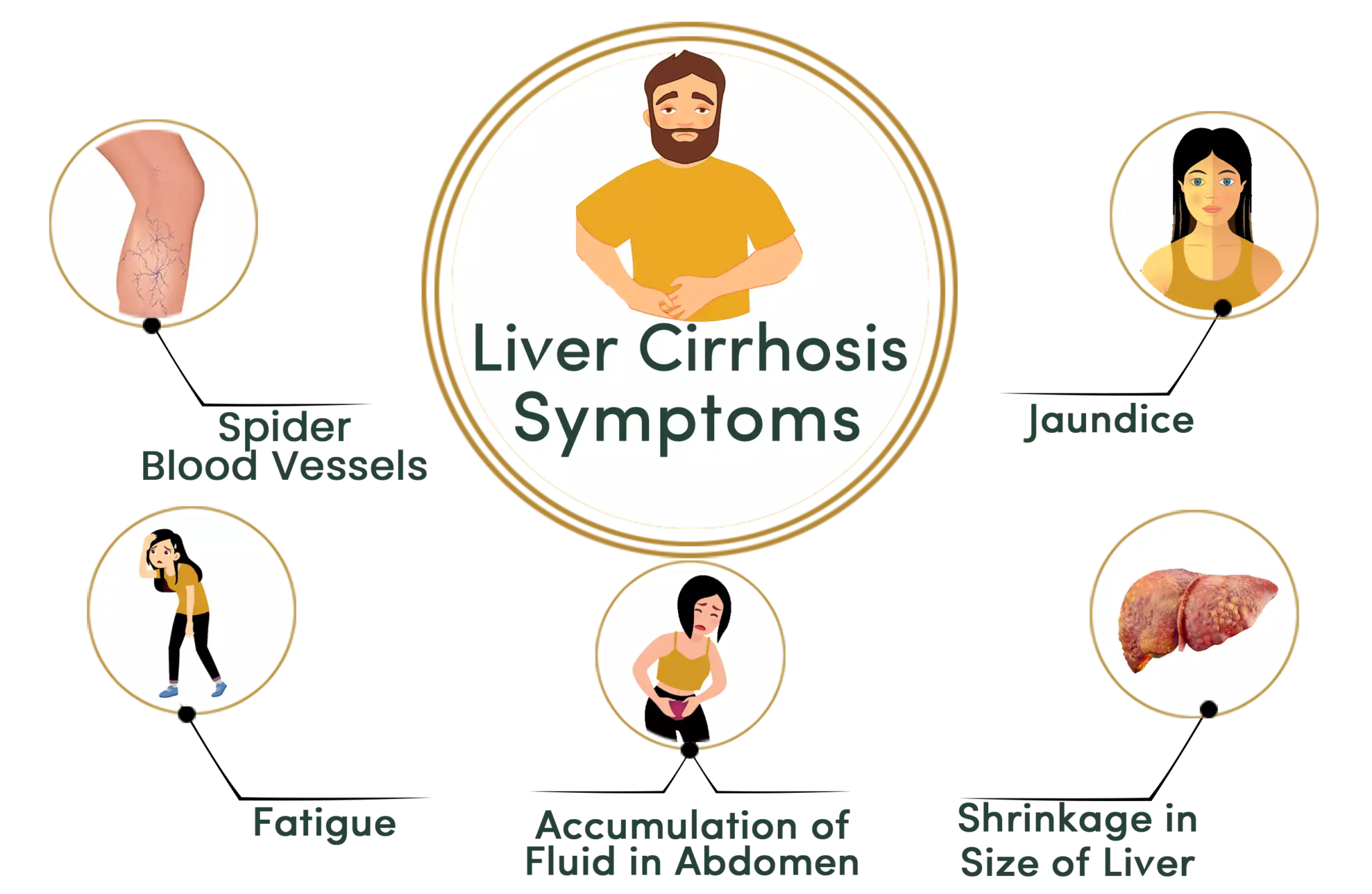 Liver Cirrhosis Ayurvedic Treatment - Durja Ayurveda