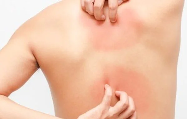 Consult Psoriasis